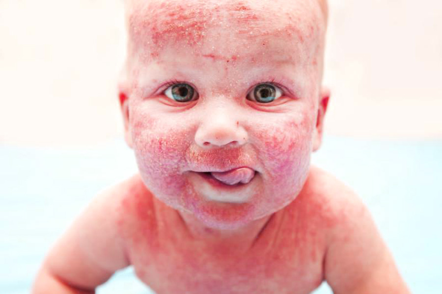 bambino con dermatite