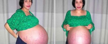 Madre incinta di 8 gemelli
