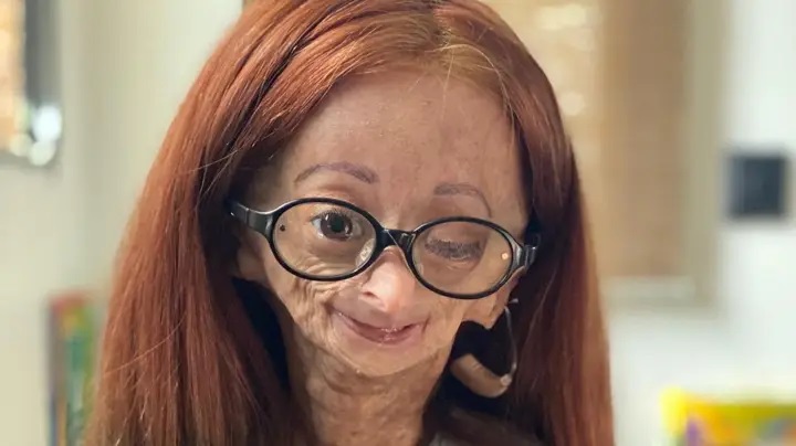 Progeria