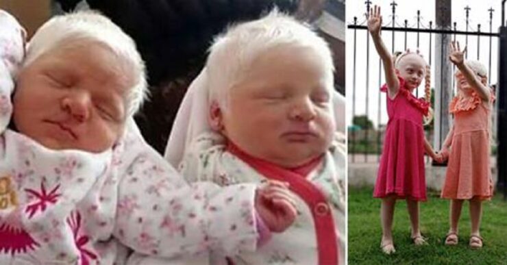 Donna partorisce due gemelle albine