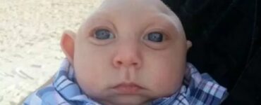 Jaxon microcefalia