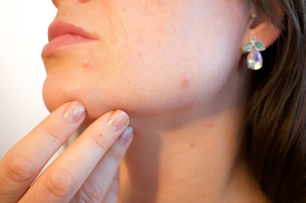 falsi miti sull'acne