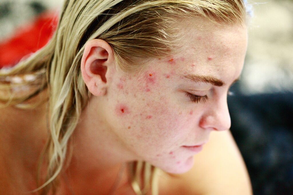 Come stare meglio con l'acne