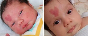 Bimbo con voglia a forma di cuore