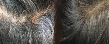 Rimedi contro i capelli grigi
