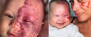 Neonato di 4 mesi: laser per la rimozione delle voglie