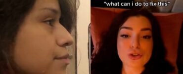 ragazzo l'ha tradita: si fa pagare l'intervento al naso