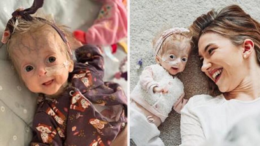 Eline, la bambina nata con progeria