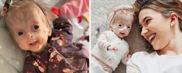 Eline, la bambina nata con progeria