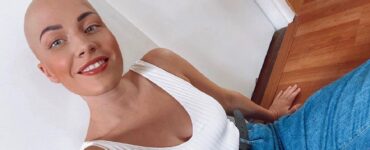 Donna con alopecia presa in giro dall'adolescenza