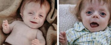 Neonato con osteogenesi imperfetta o malattia delle ossa fragili